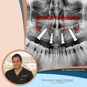 Dr. Nariman Saadat Oral Surgeon for Dental Implants