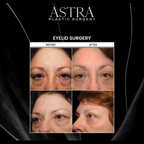 Eyelid surgery, also known as blepharoplasty, can reduce the appearance of fine lines and wrinkles around the eyes as well as sagging tissues, puffiness, and undereye bags. Signs of aging can be resolved with eyelid surgery for a refreshed and youthful appearance.