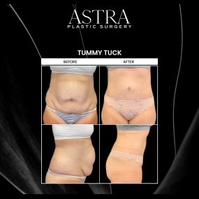 Following pregnancy or substantial weight loss, many patients find that their midsection isn’t as firm or sculpted as it once was. Tummy tuck surgery can tighten stretched abdominal muscles and skin and remove excess skin for natural-looking curves. Our plastic surgeons are board-certified with a special focus on helping patients regain a firmer and slimmer midsection with tummy tuck surgery in Cumming, GA.
