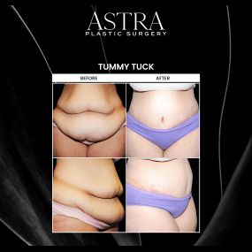 Body sculpting can enhance the contours and proportions of your body while accentuating your figure. Various body contouring techniques are available to treat troublesome areas of fat, bulges, excess and loose skin, and more. These techniques provide a sculpted and toned body.