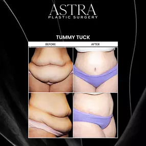 Body sculpting can enhance the contours and proportions of your body while accentuating your figure. Various body contouring techniques are available to treat troublesome areas of fat, bulges, excess and loose skin, and more. These techniques provide a sculpted and toned body.