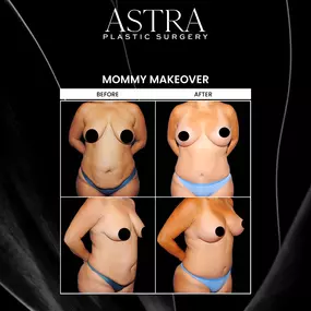 Mommy Makeover targets the upper, mid, and lower body using a combination of plastic surgeries to address multiple problem areas in one procedure. Mommy makeovers help patients achieve their pre-pregnancy bodies while building back self-confidence in their appearance.