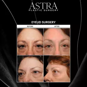 Eyelid surgery, also known as blepharoplasty, can reduce the appearance of fine lines and wrinkles around the eyes as well as sagging tissues, puffiness, and undereye bags. Signs of aging can be resolved with eyelid surgery for a refreshed and youthful appearance.