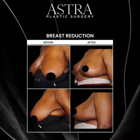 Breast reduction can reduce breast size and achieve natural-looking breast shape. Overly large breasts can cause strain on the body, cause chaffing, make it difficult to exercise, and more. Patients who have larger breasts can achieve natural-looking symmetry and shape with breast reduction surgery.