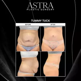 Following pregnancy or substantial weight loss, many patients find that their midsection isn’t as firm or sculpted as it once was. Tummy tuck surgery can tighten stretched abdominal muscles and skin and remove excess skin for natural-looking curves. Our plastic surgeons are board-certified with a special focus on helping patients regain a firmer and slimmer midsection with tummy tuck surgery in Cumming, GA.