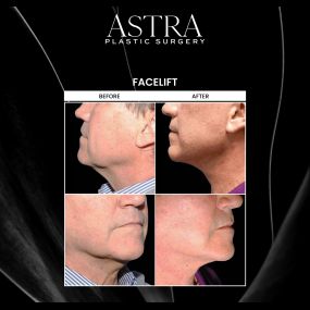 Facelift surgery can address the most common signs of aging. Fine lines, wrinkles, creases, and sagging skin can be prominent factors of aging. A facelift helps restore a natural, youthful appearance by tightening and lifting your facial tissue to enhance facial contours.
