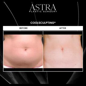 CoolSculpting is an FDA approved non-surgical procedure that can slim and tone the body by reducing unwanted fat. CoolSculpting does not require anesthesia, needles, or injections. Patients can return to daily activities immediately after treatment.