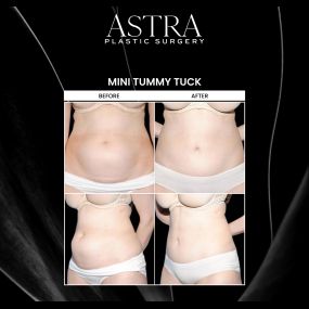 A mini tummy tuck is a body sculpting procedure that can provide patients with a more toned, flatter-looking midsection. This procedure targets the lower abdomen. A mini tummy tuck can restore natural-looking contours of the body without lengthy downtime following the procedure.