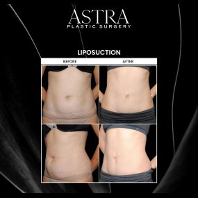 Liposuction can eliminate stubborn fat and sculpt the body while improving the natural contours and proportions of your physique. Patients undergoing liposuction can attain a more sculpted figure and natural-looking results.