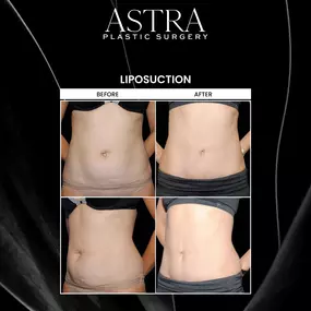 Liposuction can eliminate stubborn fat and sculpt the body while improving the natural contours and proportions of your physique. Patients undergoing liposuction can attain a more sculpted figure and natural-looking results.