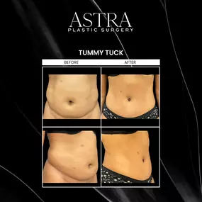 Tummy tuck surgery in Marietta, addresses excess abdominal fat and skin. Tummy tuck surgery removes stubborn pockets of fat following weight loss or pregnancy to achieve a flatter, toned midsection. Undergoing a tummy tuck can repair weakened or separated stomach muscles, improve contours, reduce skin irritation, and more.