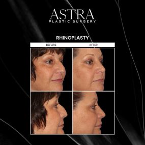 Rhinoplasty, also known as nose surgery, can improve the appearance of the nose and balance facial features. Rhinoplasty can decrease the size of the nose, reduce the nasal tip, enhance facial features, correct breathing issues, boost self-esteem, and more. A nose job is among the most common facial plastic surgeries, as it provides patients with a symmetrical facial profile and natural-looking results.