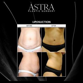 Liposuction can remove unwanted fat and bulges to accentuate your figure. Through various body sculpting and liposuction techniques, the contours and proportions of your body are enhanced to attain a sculpted and toned body. This patient underwent liposuction and tummy tuck for beautifully contoured results.