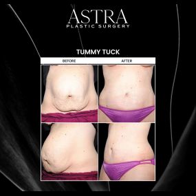 Tummy tuck surgery can address loose, sagging skin around the midsection while also tightening underlying abdominal muscles for a flatter stomach. Aging, pregnancy, breastfeeding, and substantial weight loss are just a few factors that can stretch abdominal muscles. A tummy tuck can remove excess skin, reshape loose skin, and firm stomach muscles to accentuate contours.