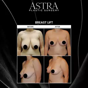 Breast lift can achieve firmer, shapelier breasts. Sagging and drooping of the breasts can cause the breasts to appear smaller and is common over time due to age and other factors, such as pregnancy and breastfeeding. Breast lift is performed to raise and reshape the breasts by tightening the supportive breast tissue.