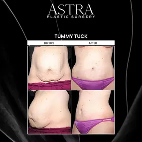 Tummy tuck surgery can address loose, sagging skin around the midsection while also tightening underlying abdominal muscles for a flatter stomach. Aging, pregnancy, breastfeeding, and substantial weight loss are just a few factors that can stretch abdominal muscles. A tummy tuck can remove excess skin, reshape loose skin, and firm stomach muscles to accentuate contours.