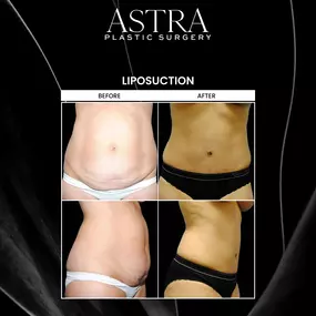 Liposuction can remove unwanted fat and bulges to accentuate your figure. Through various body sculpting and liposuction techniques, the contours and proportions of your body are enhanced to attain a sculpted and toned body. This patient underwent liposuction and tummy tuck for beautifully contoured results.