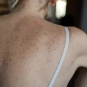 Advanced Dermatology & Skin Cancer Specialists -woman freckled back