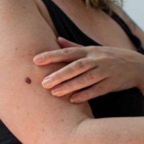 Advanced Dermatology & Skin Cancer Specialists - woman showing mole on arm