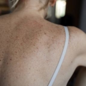 Desert Dermatology & Skin Cancer Specialists - woman freckled back