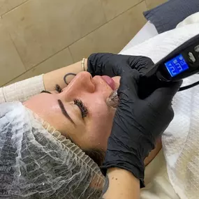 Microneedling-Dermapen-Centre-d-estetica-Belari-1.jpg