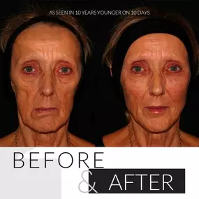 Before & After Botox and Filler treatment