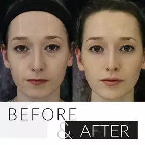 Before & After Botox full face treatment