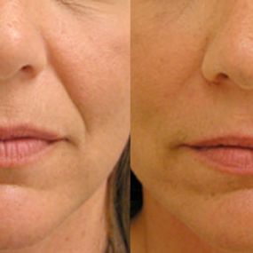 Juvederm Before & After