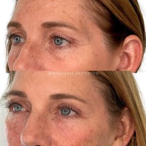 Temples & PRF undereyes