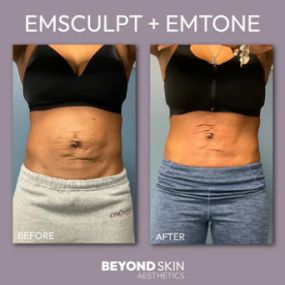 Emsculpt B&A