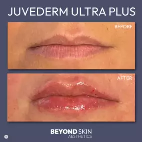 Juvederm Ultra Plus B&A