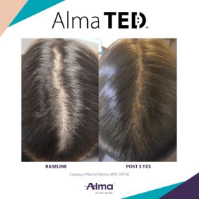 Alma TED Hair Restoration