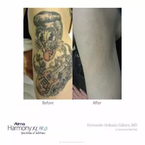 ClearLift Tattoo Removal
