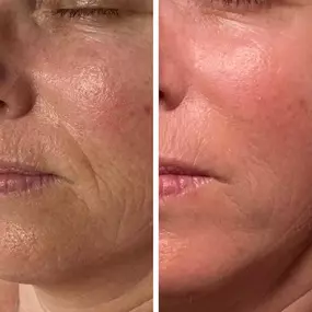 Microneedling Reducing Wrinkles And Fine Lines - Waters Aesthetics in Phoenix, AZ