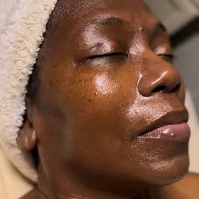 Results After Custom Facial - Waters Aesthetics - Phoenix, AZ