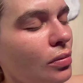 Post Facial Skin After Customized Facial in Phoenix, AZ - Waters Aesthetics