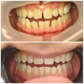 Invisalign before and after