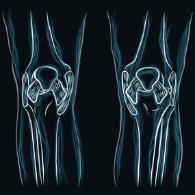 Knee surgery can treat a variety of conditions that affect the knee joint such as knee arthroscopy, ACL surgery, and knee replacement surgery. Knee pain can be caused by deterioration of the knee structure, trauma, or injury. This can be caused by common knee conditions such as bursitis, arthritism or osteoarthritis. As a result, the knee can begin to swell, become stiff, and cause discomfort. After a diagnosis, surgical or non-surgical treatment can be utilized to relieve the pain in the knee.