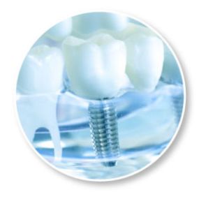 What Are Dental Implants?
A healthy smile plays a vital role in the way you look and feel, but millions of people are affected by a change in appearance and health due to missing teeth. Fortunately, the innovation of dental implants is available as an optimal solution for tooth replacement that can help replace the look and function of your natural teeth. By acting as substitute tooth roots, dental implants provide a stable foundation for replacement teeth that stay securely in place, allowing y