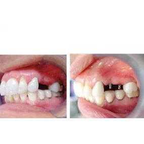 Mini Dental Implant Patient in Melbourne, FL | Victor C. Apel, DMD