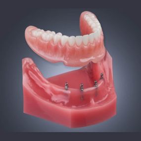 Implant Dentures in Las Vegas