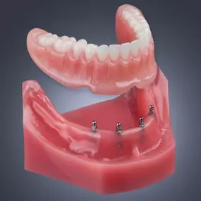 Implant Dentures in Las Vegas