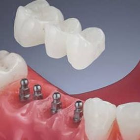 Dental Bridges in Las Vegas