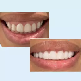 As a cosmetic dentist, Dr. Camacho specializes in All-On-Four Implants, a full smile corrective treatment that helps patients regain the confidence and functionality of their natural teeth. If you're in need of a cosmetic dentist in Houston, TX, who prioritizes oral health and patient care, look no further than Dr. Jessie Carolina Camacho and JC Dental Care.