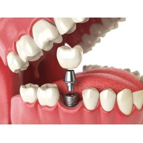 Bild von BDG Advanced Dental Implant Center