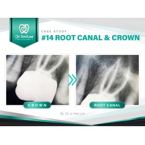 Case Study: #14 RCT and Crown