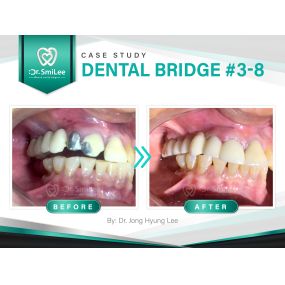 Case Study: Dental Bridge Tooth #3- 8