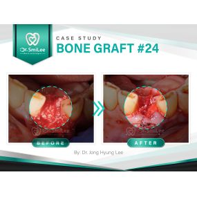 Case Study: Bone graft #24