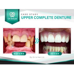 Case Study: Upper Complete Denture