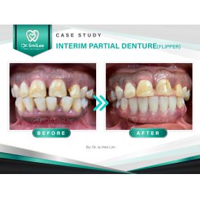 Case Study: Interim partial denture (flipper)